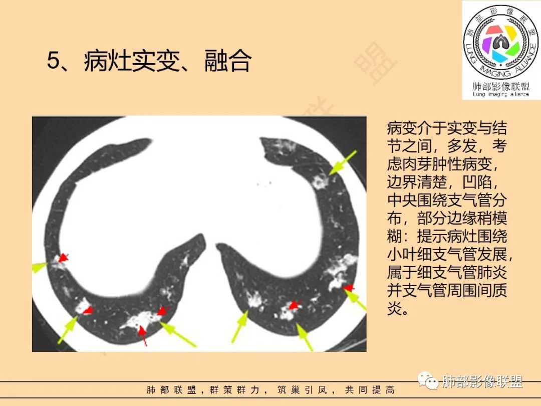 影像PPT - 【PPT】肺炎支原体肺炎影像分析-17 影像PPT - 【PPT】肺炎支原体肺炎影像分析-17