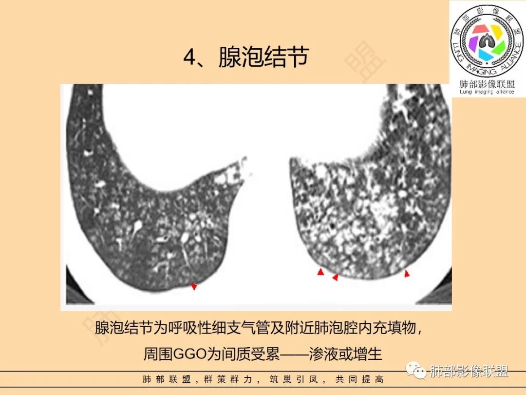 影像PPT - 【PPT】肺炎支原体肺炎影像分析-16 影像PPT - 【PPT】肺炎支原体肺炎影像分析-16