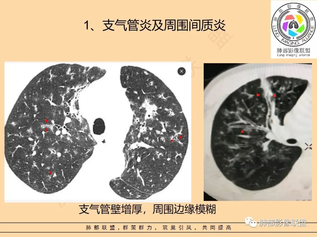 影像PPT - 【PPT】肺炎支原体肺炎影像分析-13 影像PPT - 【PPT】肺炎支原体肺炎影像分析-13