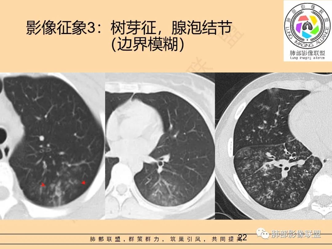 影像PPT - 【PPT】肺炎支原体肺炎影像分析-22 影像PPT - 【PPT】肺炎支原体肺炎影像分析-22
