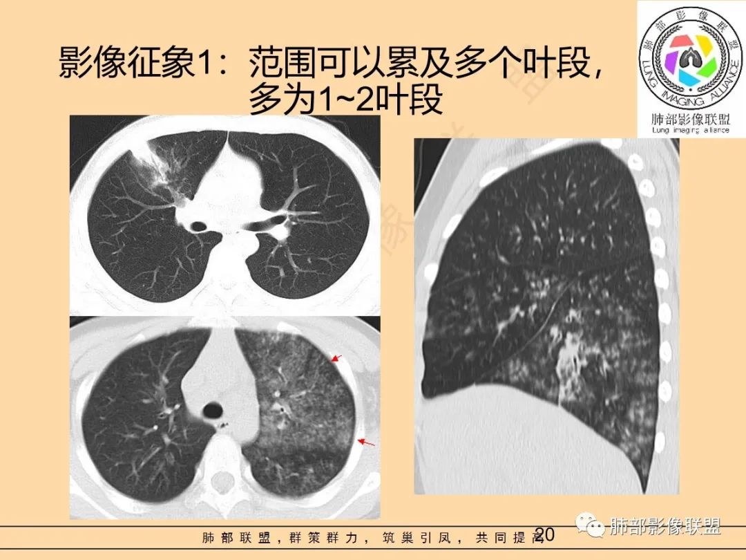 影像PPT - 【PPT】肺炎支原体肺炎影像分析-20 影像PPT - 【PPT】肺炎支原体肺炎影像分析-20