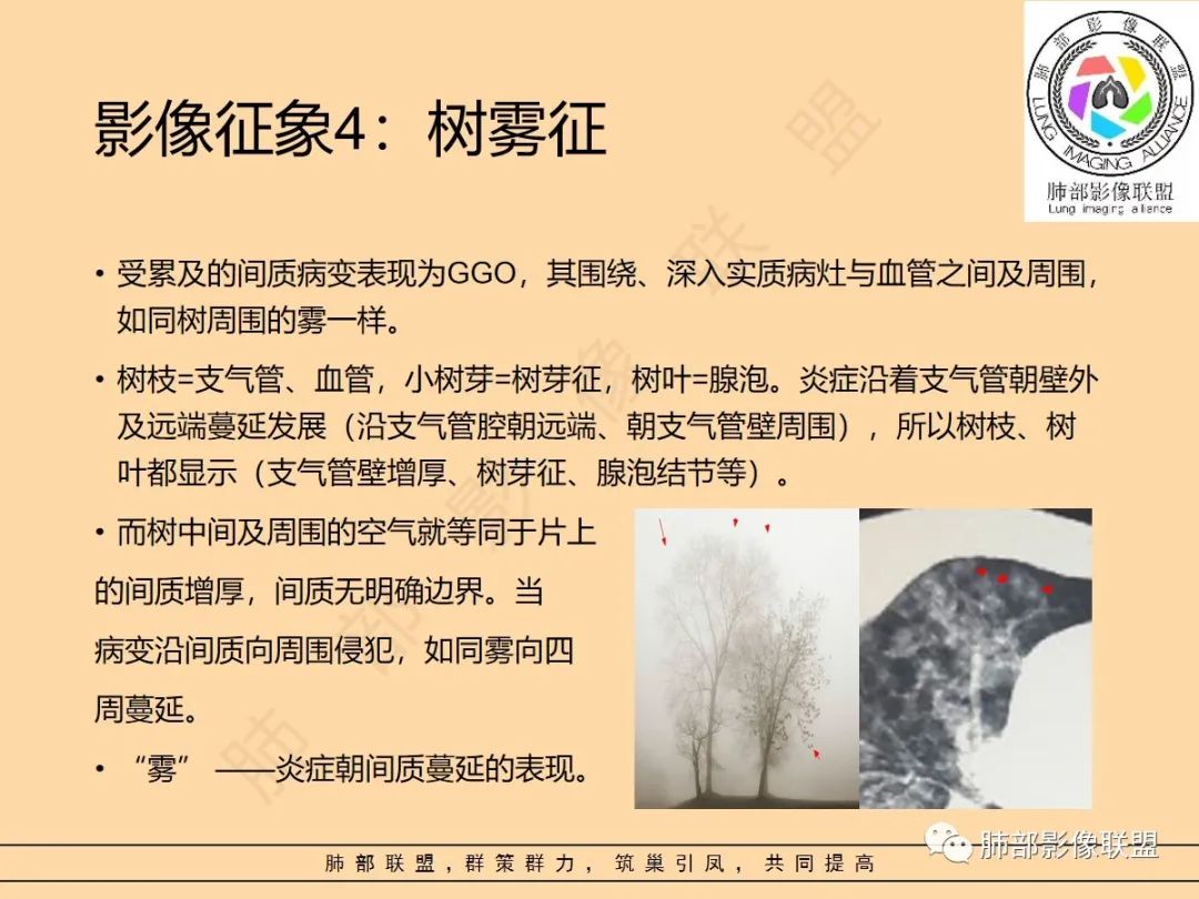 影像PPT - 【PPT】肺炎支原体肺炎影像分析-23 影像PPT - 【PPT】肺炎支原体肺炎影像分析-23
