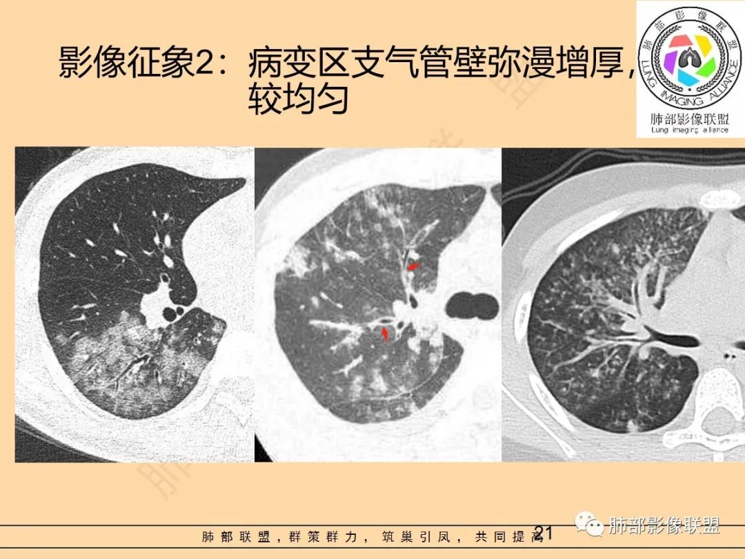 影像PPT - 【PPT】肺炎支原体肺炎影像分析-21 影像PPT - 【PPT】肺炎支原体肺炎影像分析-21