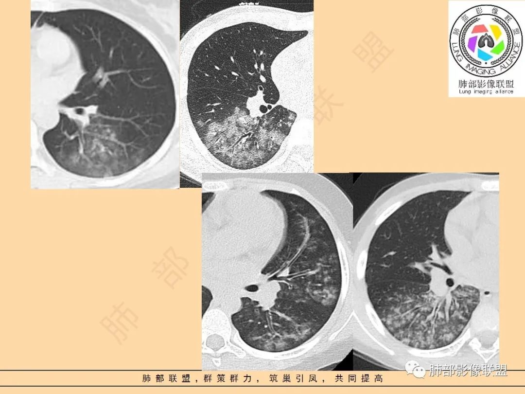 影像PPT - 【PPT】肺炎支原体肺炎影像分析-24 影像PPT - 【PPT】肺炎支原体肺炎影像分析-24