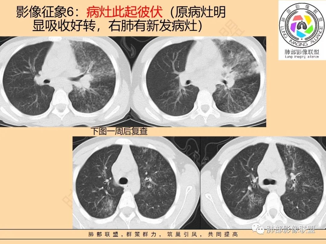 影像PPT - 【PPT】肺炎支原体肺炎影像分析-26 影像PPT - 【PPT】肺炎支原体肺炎影像分析-26