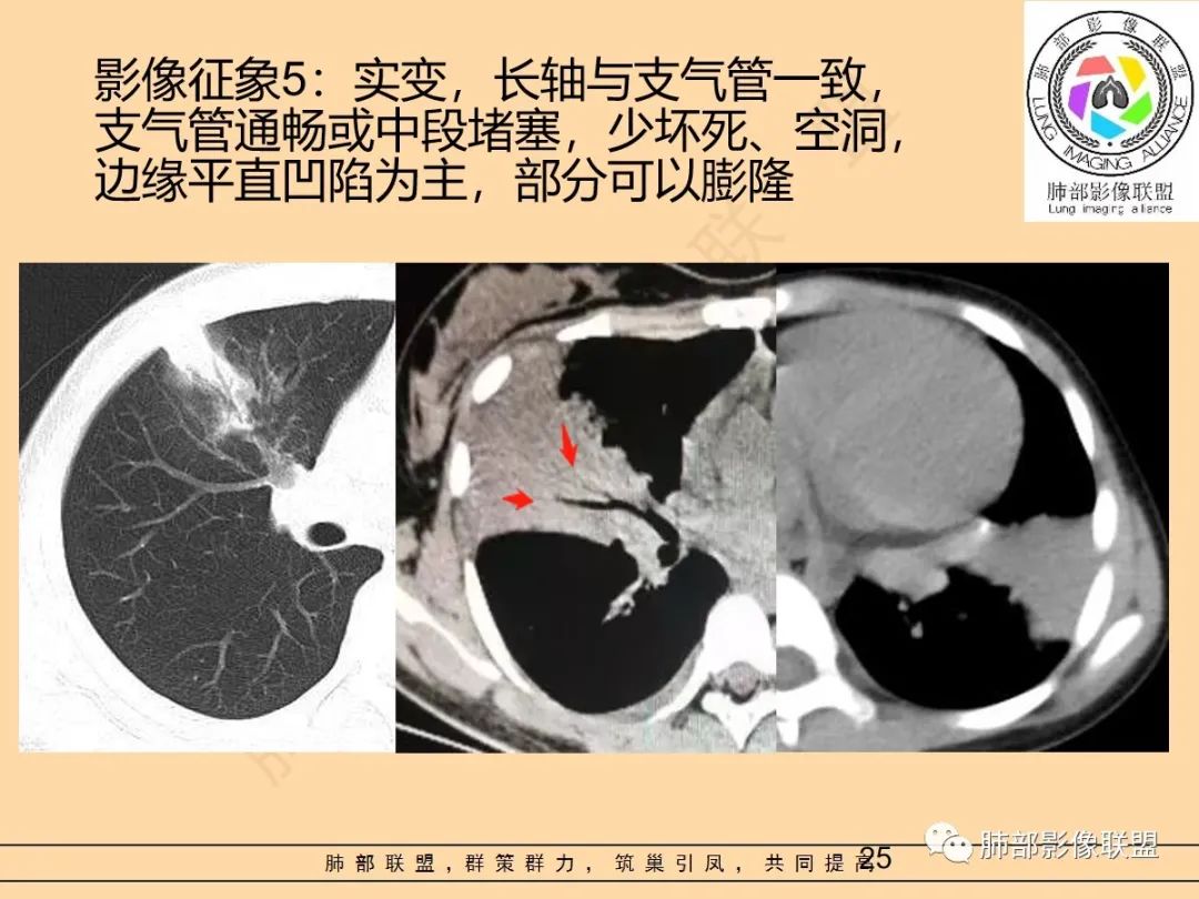 影像PPT - 【PPT】肺炎支原体肺炎影像分析-25 影像PPT - 【PPT】肺炎支原体肺炎影像分析-25