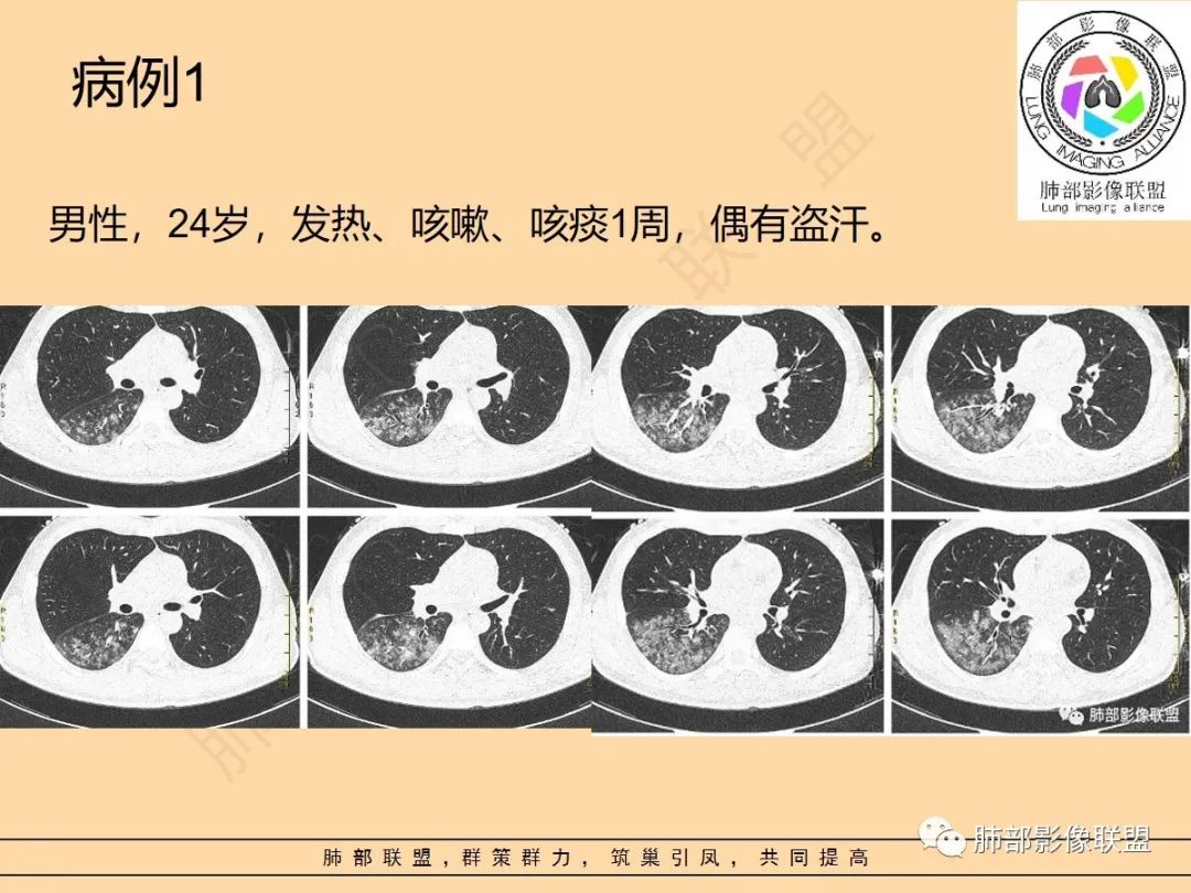 影像PPT - 【PPT】肺炎支原体肺炎影像分析-30 影像PPT - 【PPT】肺炎支原体肺炎影像分析-30