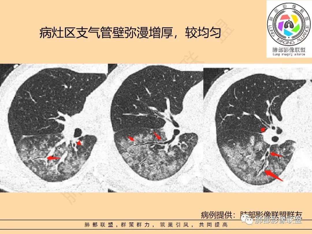 影像PPT - 【PPT】肺炎支原体肺炎影像分析-31 影像PPT - 【PPT】肺炎支原体肺炎影像分析-31