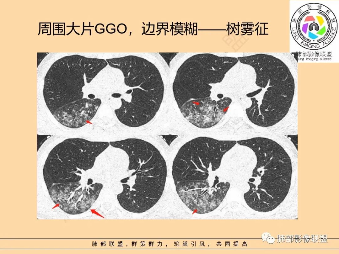 影像PPT - 【PPT】肺炎支原体肺炎影像分析-32 影像PPT - 【PPT】肺炎支原体肺炎影像分析-32