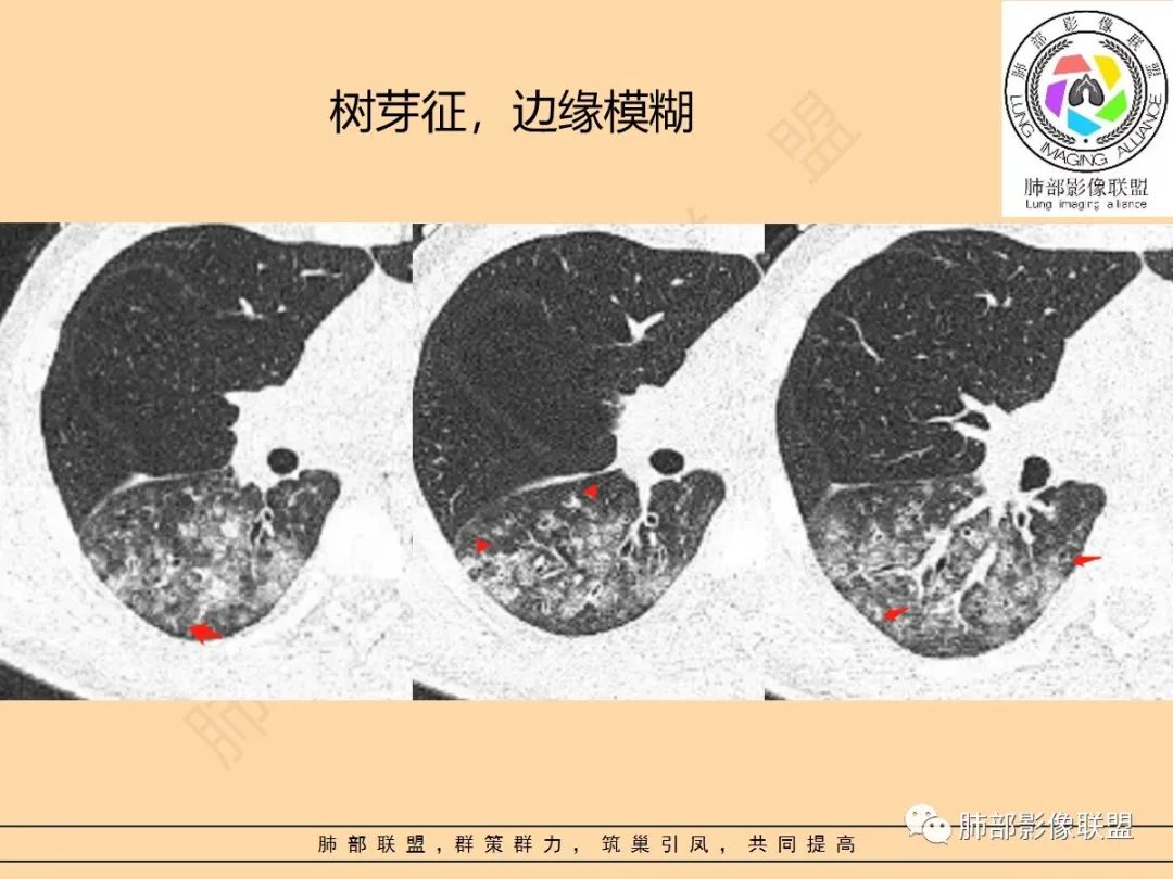 影像PPT - 【PPT】肺炎支原体肺炎影像分析-33 影像PPT - 【PPT】肺炎支原体肺炎影像分析-33