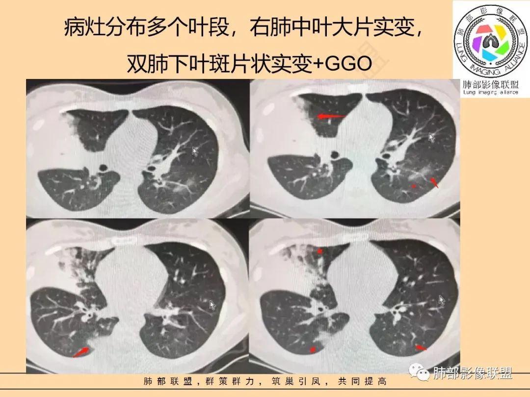 影像PPT - 【PPT】肺炎支原体肺炎影像分析-36 影像PPT - 【PPT】肺炎支原体肺炎影像分析-36