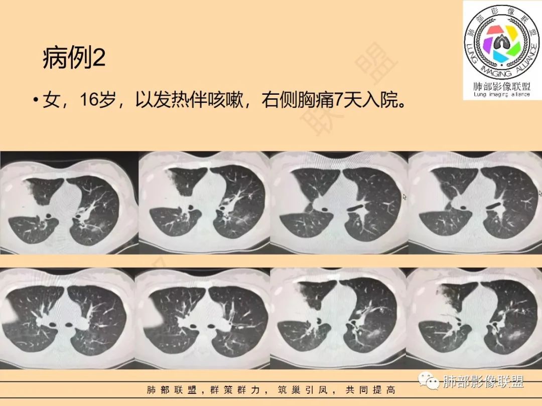 影像PPT - 【PPT】肺炎支原体肺炎影像分析-34 影像PPT - 【PPT】肺炎支原体肺炎影像分析-34