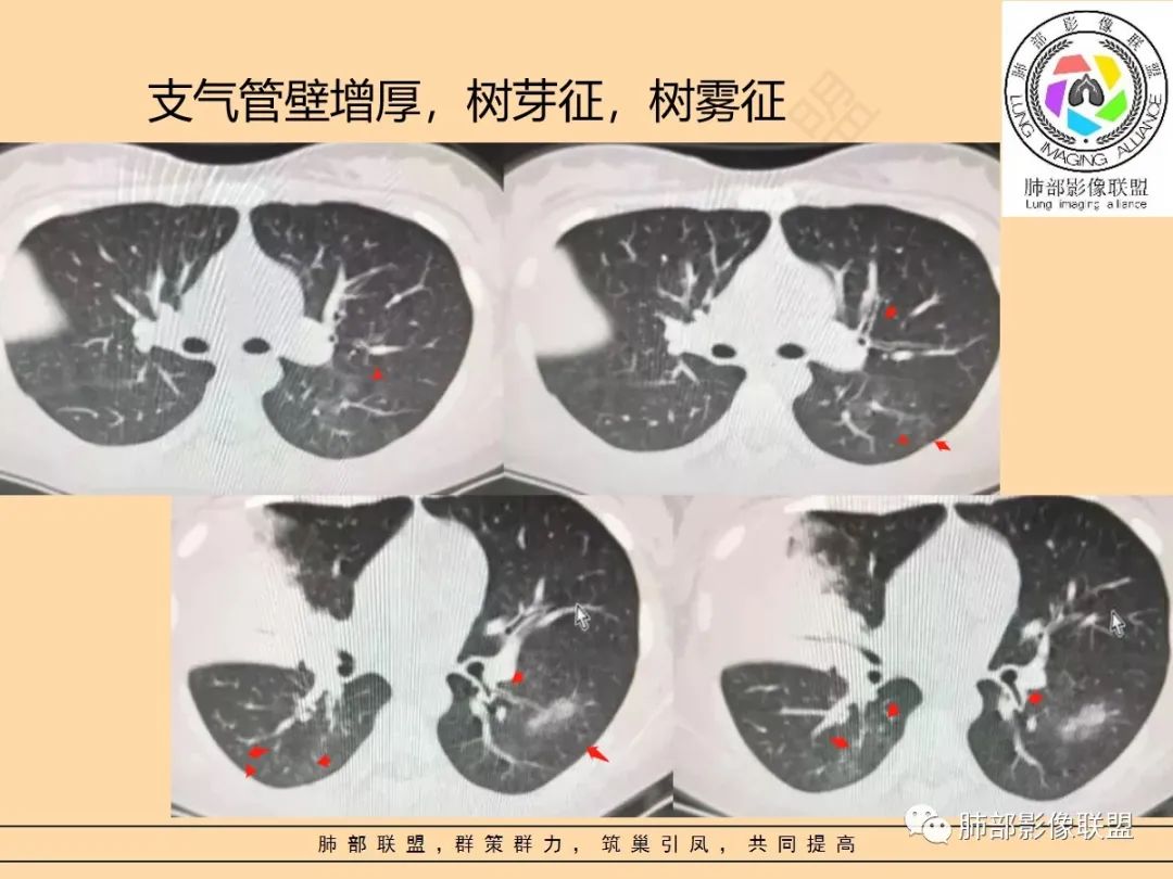 影像PPT - 【PPT】肺炎支原体肺炎影像分析-38 影像PPT - 【PPT】肺炎支原体肺炎影像分析-38