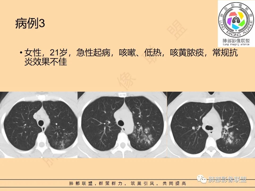 影像PPT - 【PPT】肺炎支原体肺炎影像分析-39 影像PPT - 【PPT】肺炎支原体肺炎影像分析-39