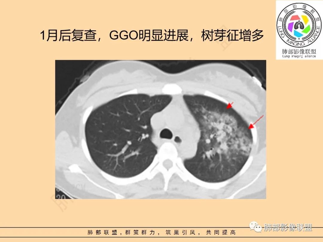 影像PPT - 【PPT】肺炎支原体肺炎影像分析-41 影像PPT - 【PPT】肺炎支原体肺炎影像分析-41