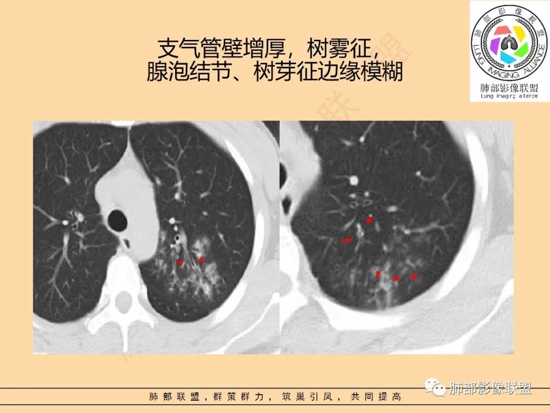 影像PPT - 【PPT】肺炎支原体肺炎影像分析-40 影像PPT - 【PPT】肺炎支原体肺炎影像分析-40