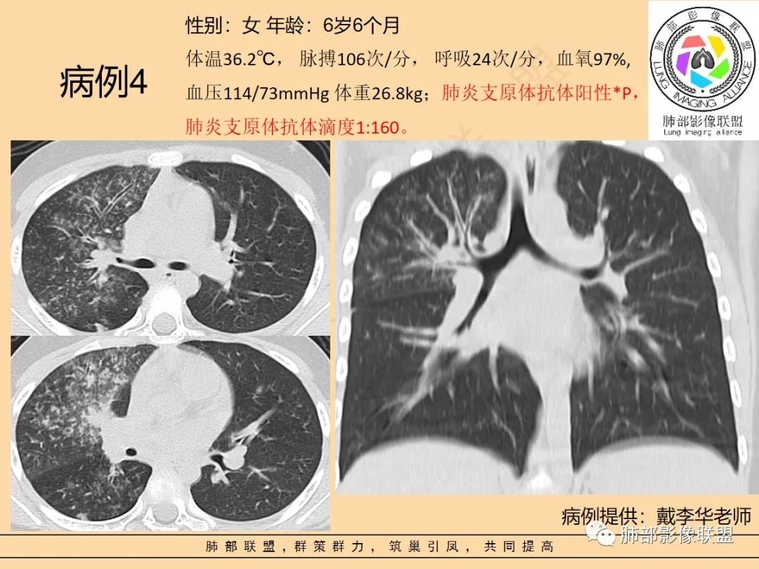 影像PPT - 【PPT】肺炎支原体肺炎影像分析-42 影像PPT - 【PPT】肺炎支原体肺炎影像分析-42