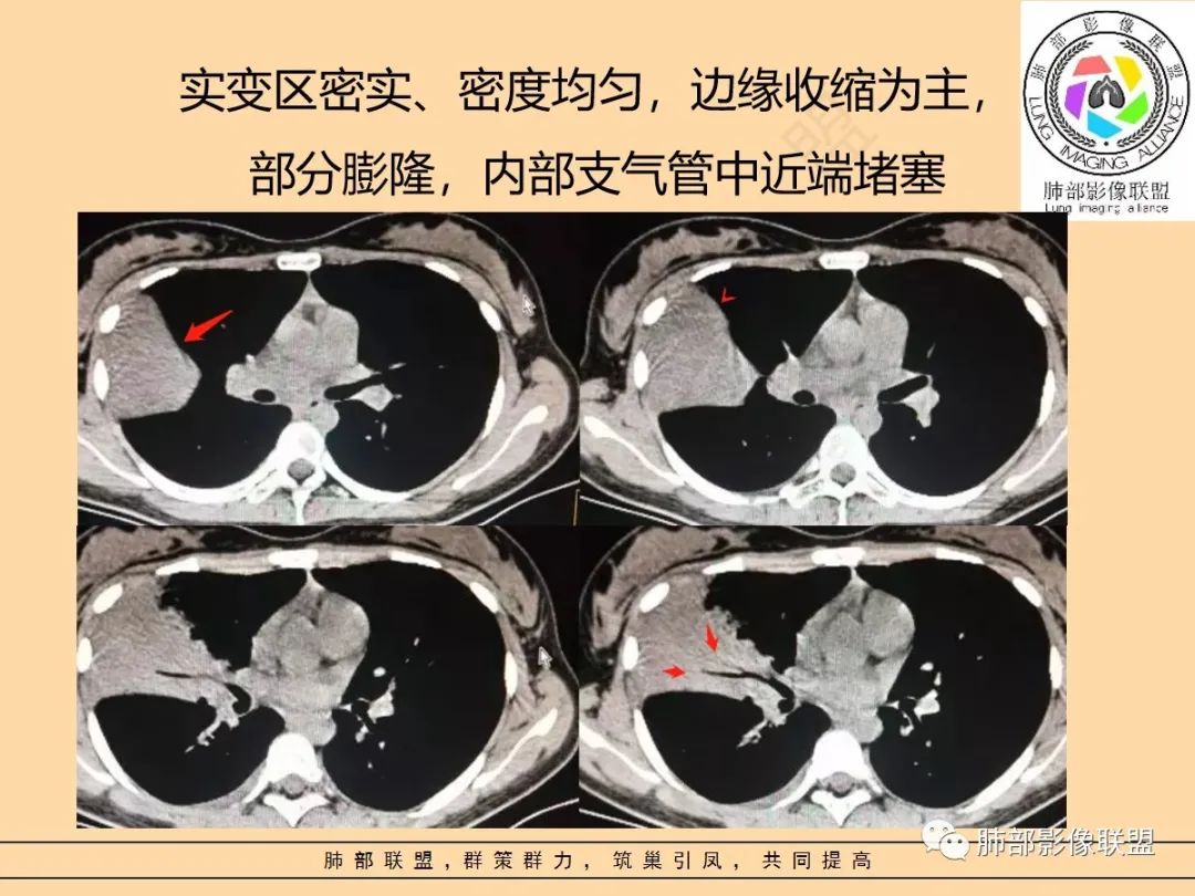 影像PPT - 【PPT】肺炎支原体肺炎影像分析-37 影像PPT - 【PPT】肺炎支原体肺炎影像分析-37