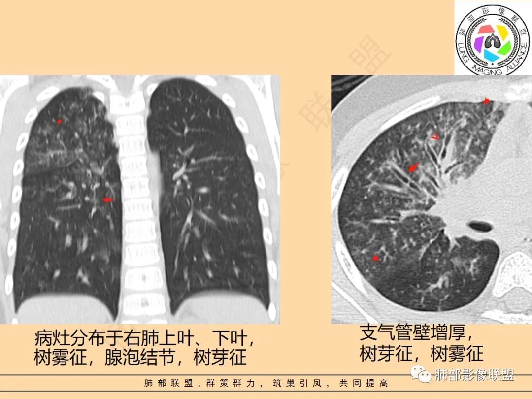 影像PPT - 【PPT】肺炎支原体肺炎影像分析-43 影像PPT - 【PPT】肺炎支原体肺炎影像分析-43