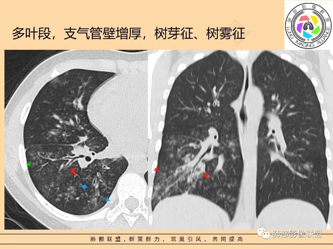 影像PPT - 【PPT】肺炎支原体肺炎影像分析-45 影像PPT - 【PPT】肺炎支原体肺炎影像分析-45
