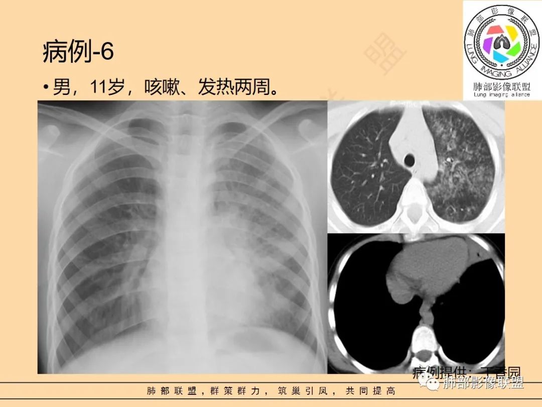 影像PPT - 【PPT】肺炎支原体肺炎影像分析-46 影像PPT - 【PPT】肺炎支原体肺炎影像分析-46