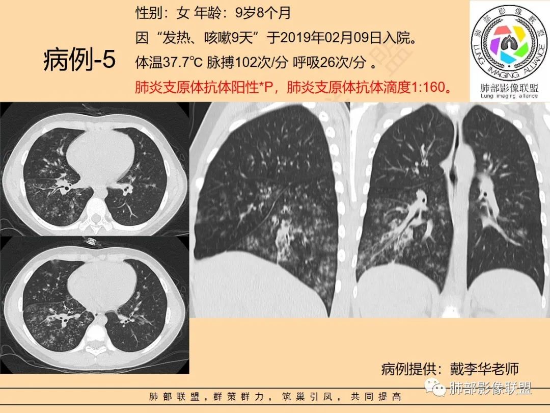影像PPT - 【PPT】肺炎支原体肺炎影像分析-44 影像PPT - 【PPT】肺炎支原体肺炎影像分析-44