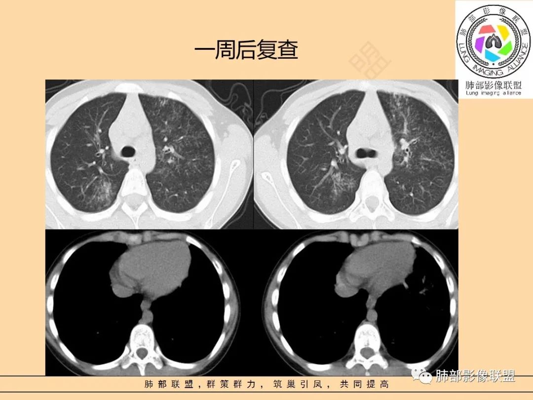 影像PPT - 【PPT】肺炎支原体肺炎影像分析-48 影像PPT - 【PPT】肺炎支原体肺炎影像分析-48