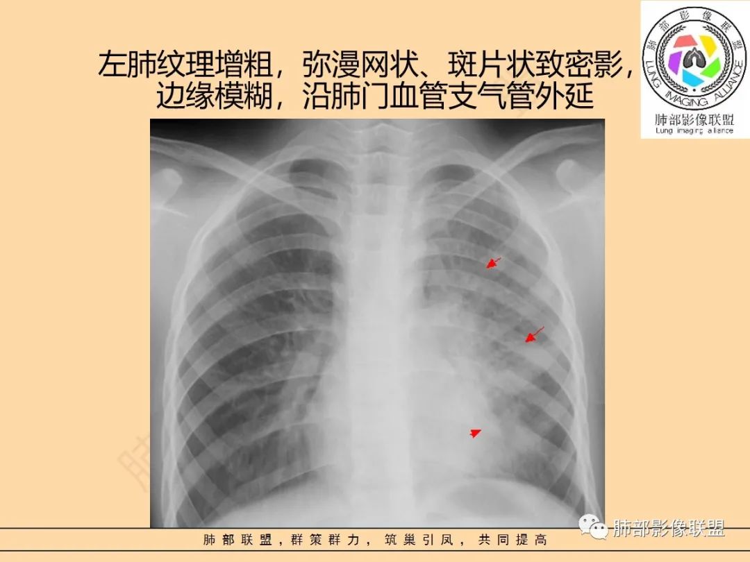影像PPT - 【PPT】肺炎支原体肺炎影像分析-49 影像PPT - 【PPT】肺炎支原体肺炎影像分析-49