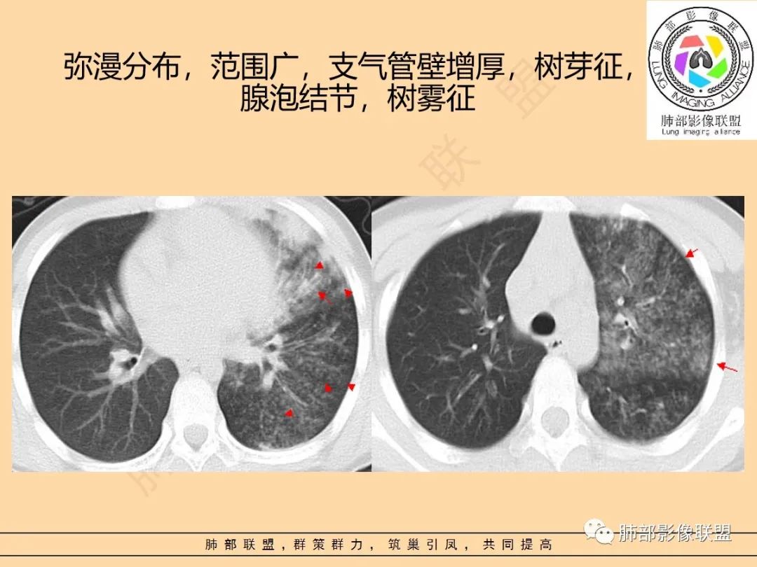 影像PPT - 【PPT】肺炎支原体肺炎影像分析-50 影像PPT - 【PPT】肺炎支原体肺炎影像分析-50