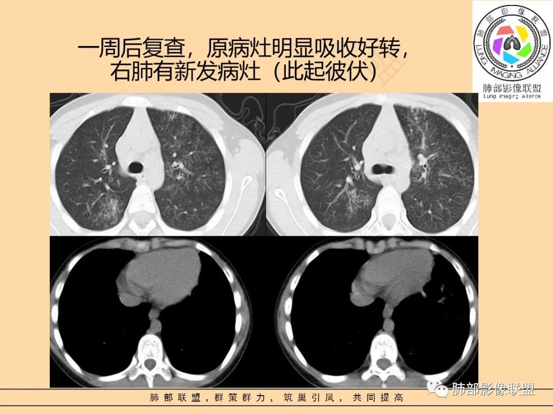 影像PPT - 【PPT】肺炎支原体肺炎影像分析-51 影像PPT - 【PPT】肺炎支原体肺炎影像分析-51