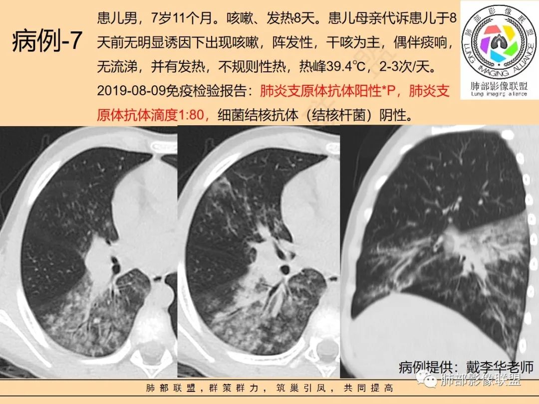 影像PPT - 【PPT】肺炎支原体肺炎影像分析-52 影像PPT - 【PPT】肺炎支原体肺炎影像分析-52