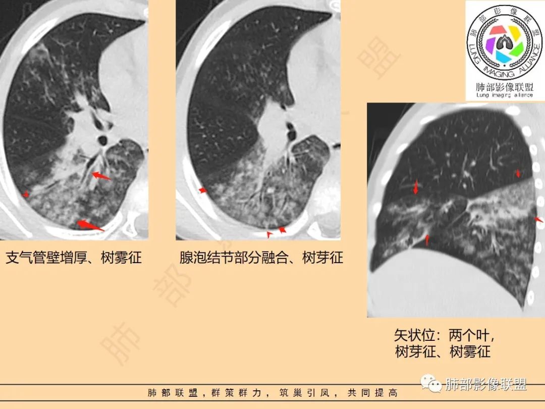 影像PPT - 【PPT】肺炎支原体肺炎影像分析-53 影像PPT - 【PPT】肺炎支原体肺炎影像分析-53