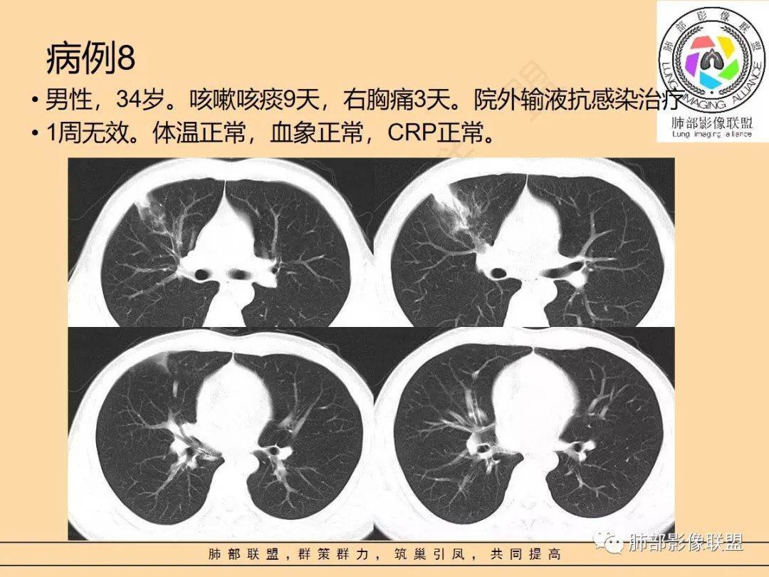 影像PPT - 【PPT】肺炎支原体肺炎影像分析-54 影像PPT - 【PPT】肺炎支原体肺炎影像分析-54