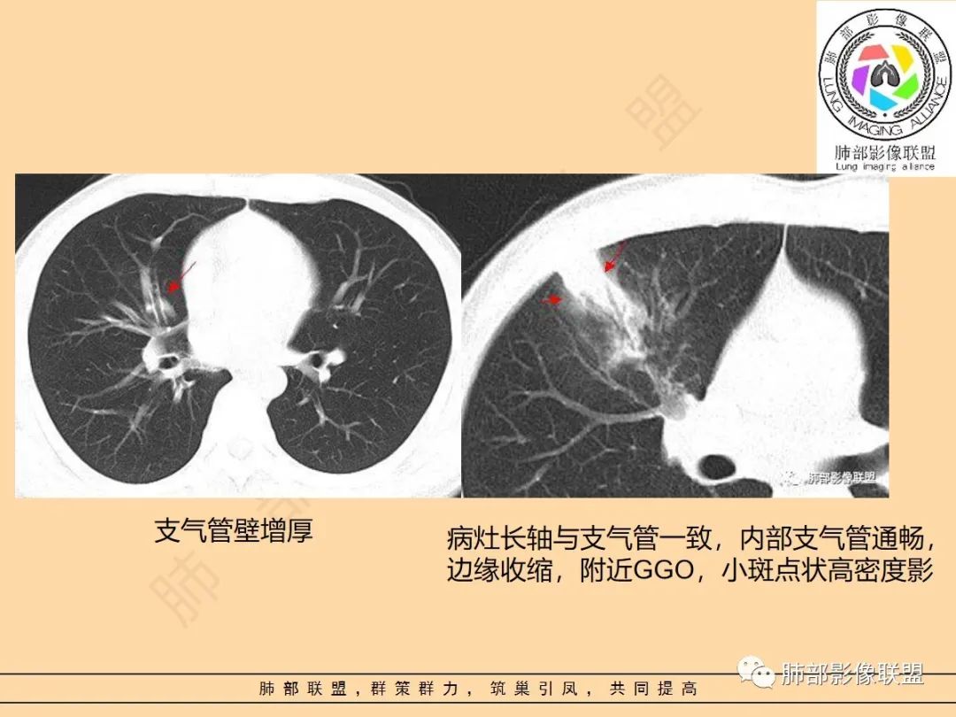 影像PPT - 【PPT】肺炎支原体肺炎影像分析-55 影像PPT - 【PPT】肺炎支原体肺炎影像分析-55