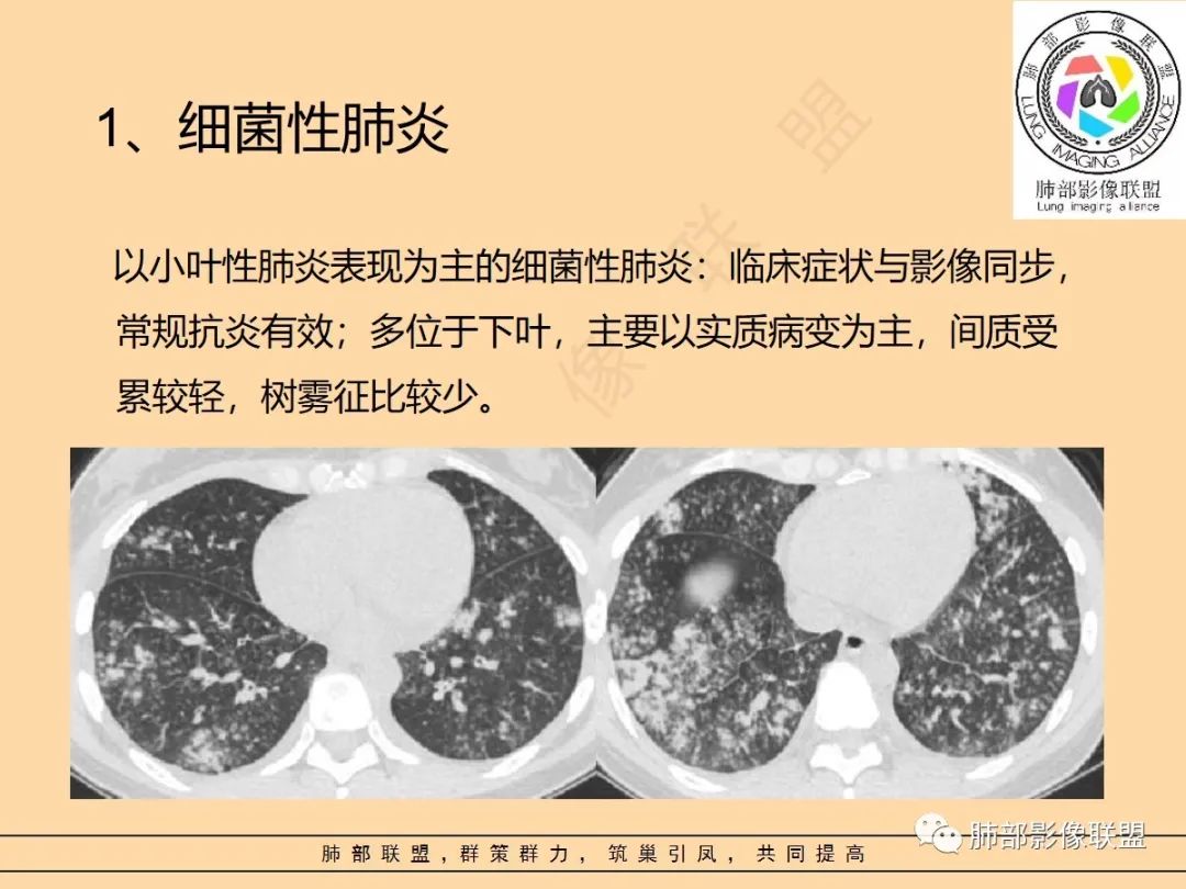 影像PPT - 【PPT】肺炎支原体肺炎影像分析-57 影像PPT - 【PPT】肺炎支原体肺炎影像分析-57