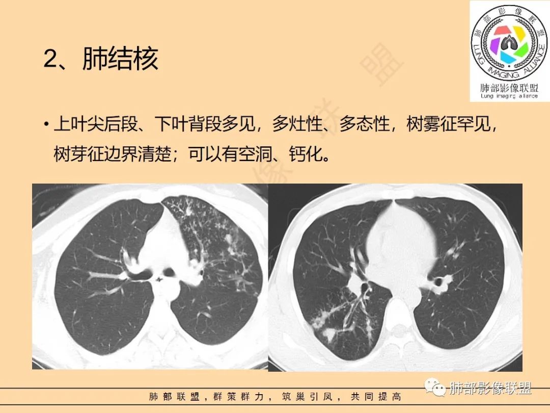 影像PPT - 【PPT】肺炎支原体肺炎影像分析-58 影像PPT - 【PPT】肺炎支原体肺炎影像分析-58