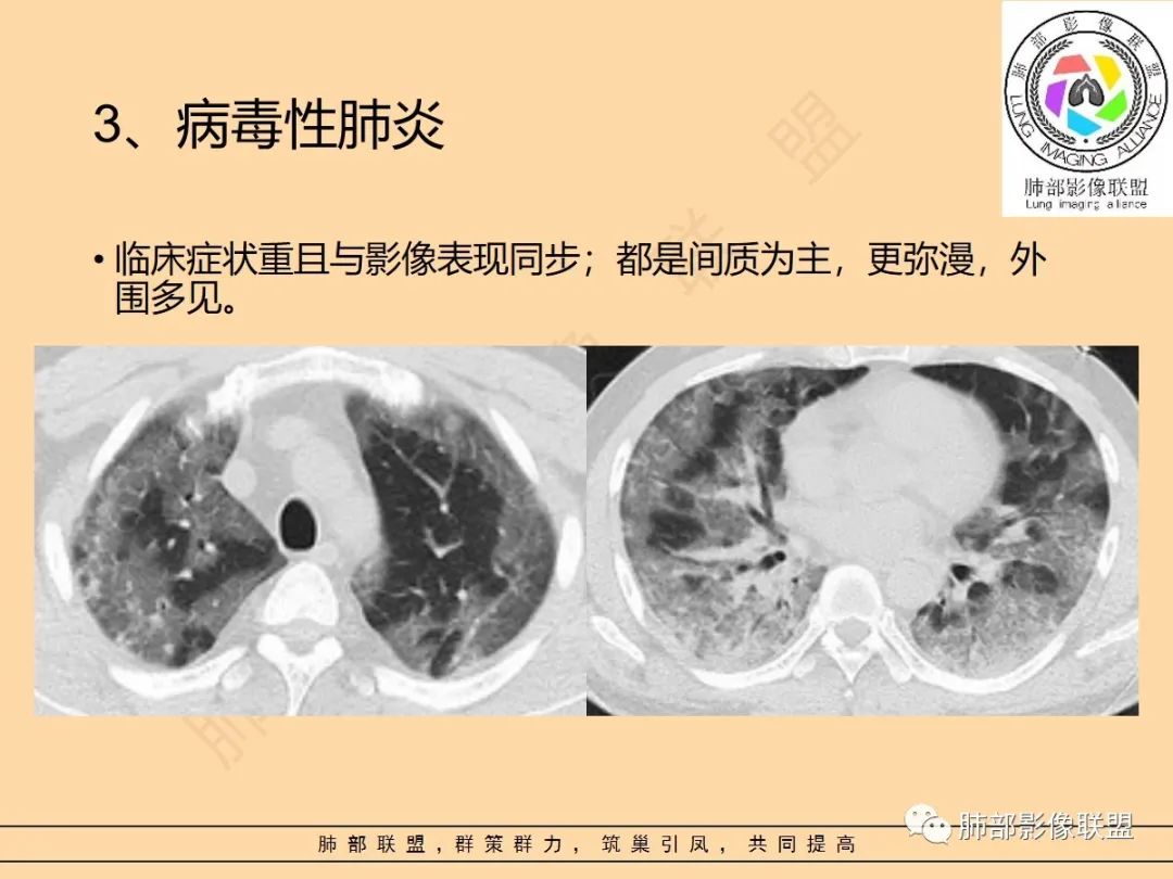 影像PPT - 【PPT】肺炎支原体肺炎影像分析-59 影像PPT - 【PPT】肺炎支原体肺炎影像分析-59