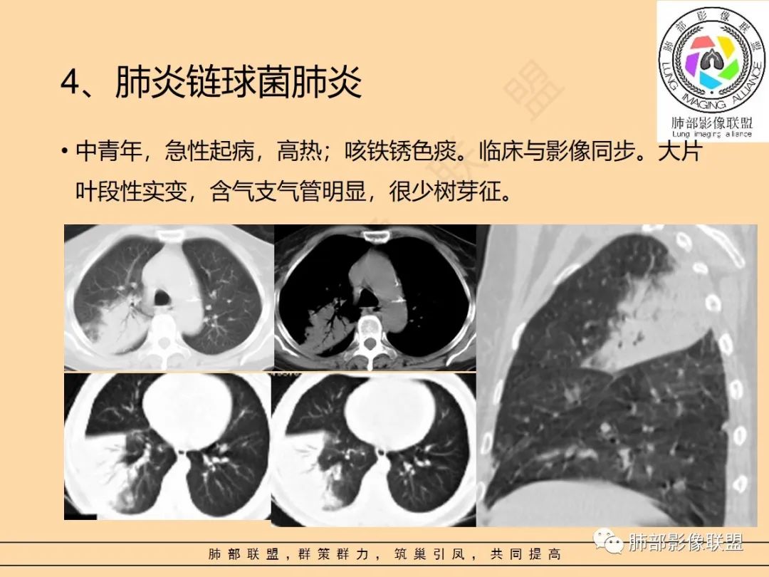 影像PPT - 【PPT】肺炎支原体肺炎影像分析-60 影像PPT - 【PPT】肺炎支原体肺炎影像分析-60
