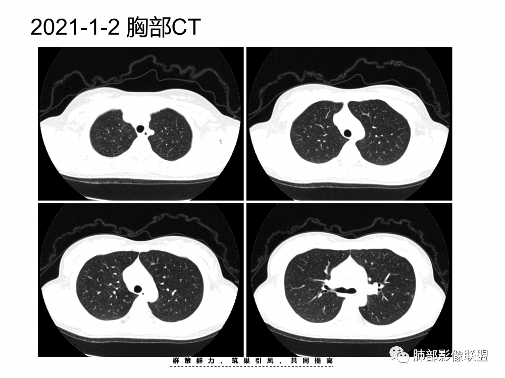 影像PPT - 【病例】支原体肺炎与肺结核的鉴别-5 影像PPT - 【病例】支原体肺炎与肺结核的鉴别-5