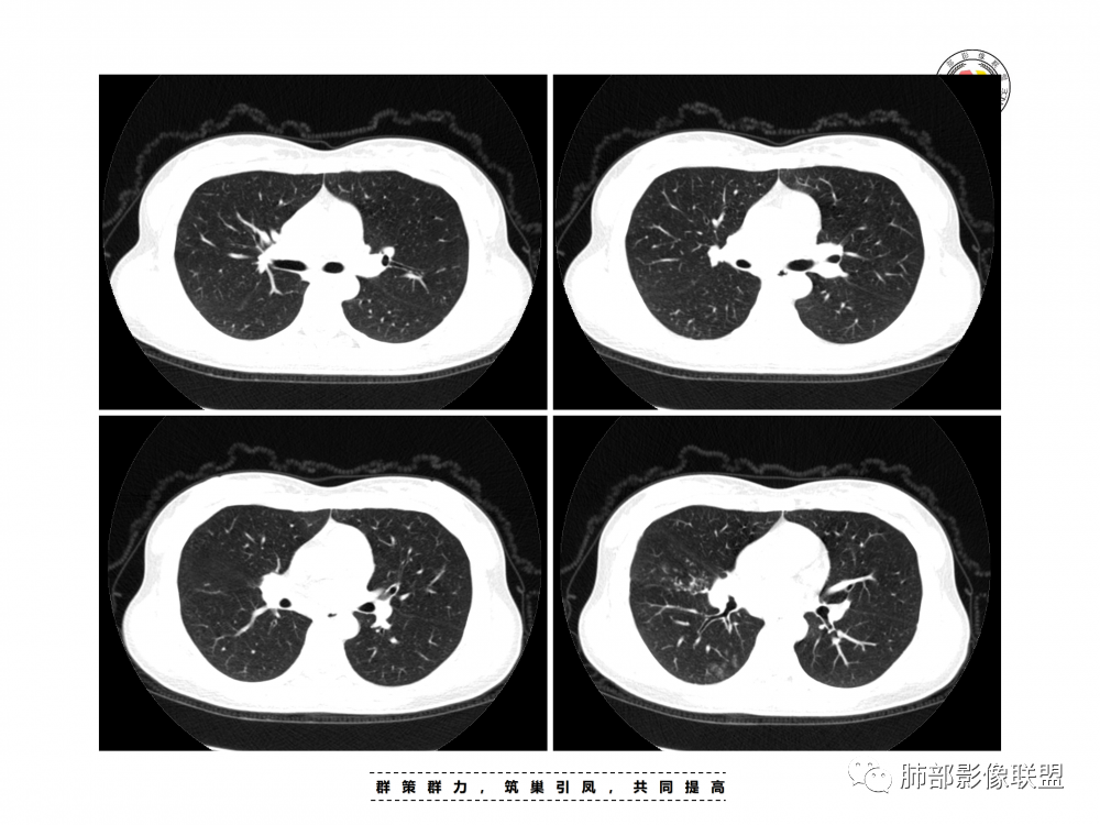 影像PPT - 【病例】支原体肺炎与肺结核的鉴别-6 影像PPT - 【病例】支原体肺炎与肺结核的鉴别-6