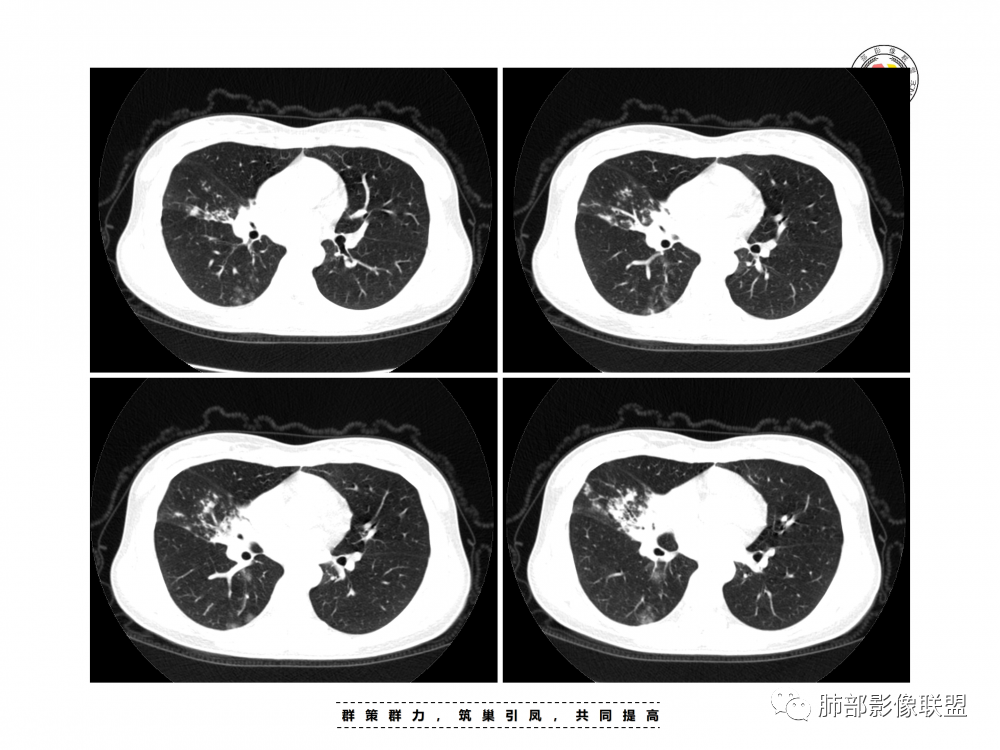 影像PPT - 【病例】支原体肺炎与肺结核的鉴别-7 影像PPT - 【病例】支原体肺炎与肺结核的鉴别-7