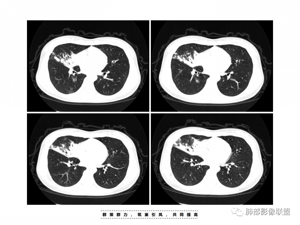 影像PPT - 【病例】支原体肺炎与肺结核的鉴别-8 影像PPT - 【病例】支原体肺炎与肺结核的鉴别-8