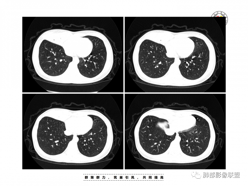 影像PPT - 【病例】支原体肺炎与肺结核的鉴别-10 影像PPT - 【病例】支原体肺炎与肺结核的鉴别-10