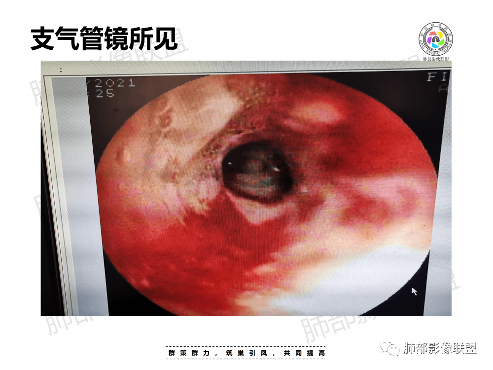 影像PPT - 【病例】支原体肺炎与肺结核的鉴别-14 影像PPT - 【病例】支原体肺炎与肺结核的鉴别-14