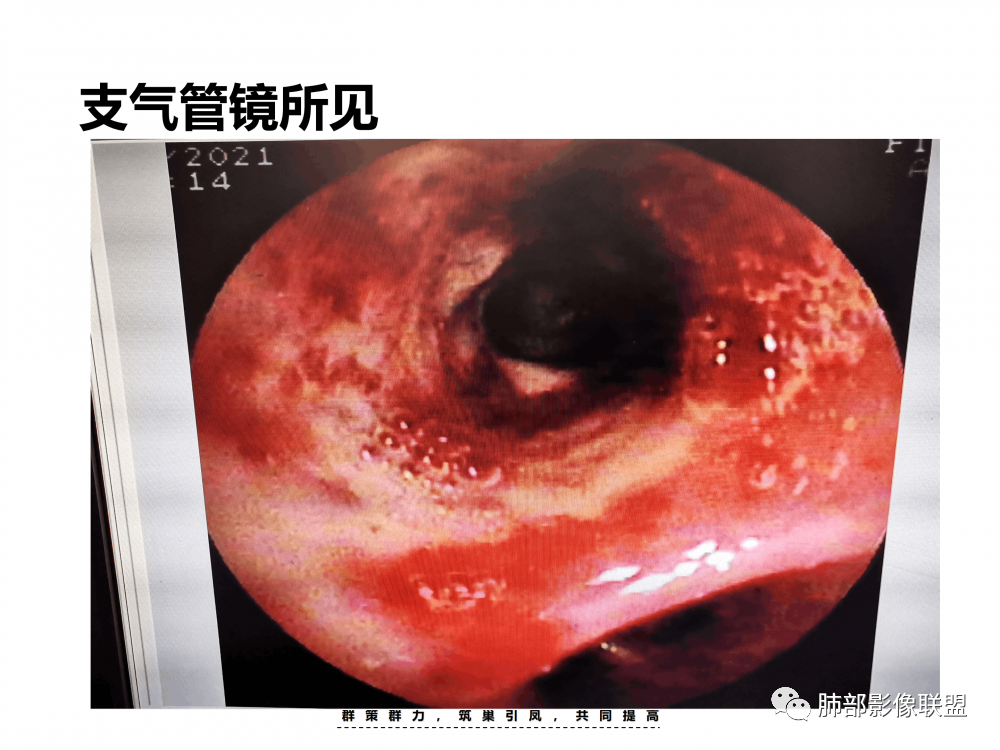 影像PPT - 【病例】支原体肺炎与肺结核的鉴别-15 影像PPT - 【病例】支原体肺炎与肺结核的鉴别-15