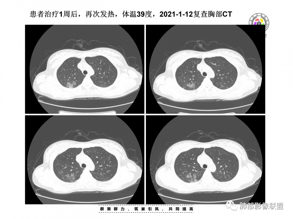 影像PPT - 【病例】支原体肺炎与肺结核的鉴别-16 影像PPT - 【病例】支原体肺炎与肺结核的鉴别-16