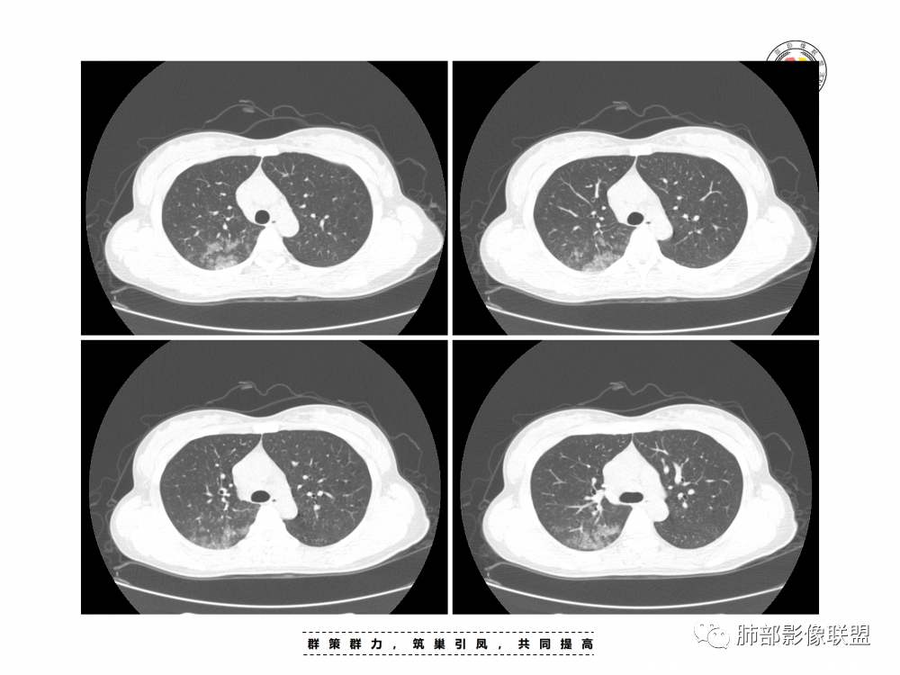影像PPT - 【病例】支原体肺炎与肺结核的鉴别-17 影像PPT - 【病例】支原体肺炎与肺结核的鉴别-17