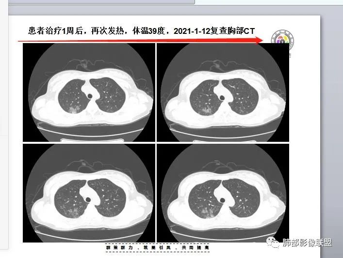 影像PPT - 【病例】支原体肺炎与肺结核的鉴别-23 影像PPT - 【病例】支原体肺炎与肺结核的鉴别-23
