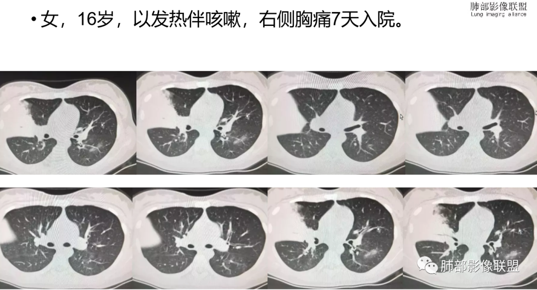 影像PPT - 【病例】支原体肺炎与肺结核的鉴别-31 影像PPT - 【病例】支原体肺炎与肺结核的鉴别-31