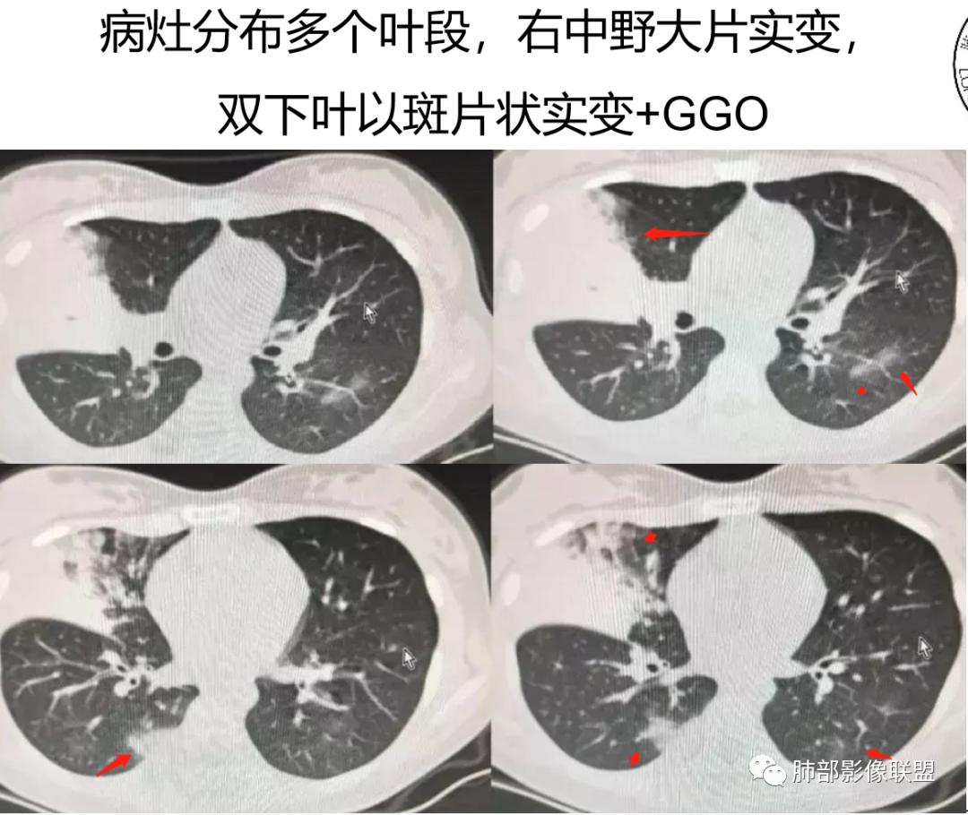 影像PPT - 【病例】支原体肺炎与肺结核的鉴别-33 影像PPT - 【病例】支原体肺炎与肺结核的鉴别-33